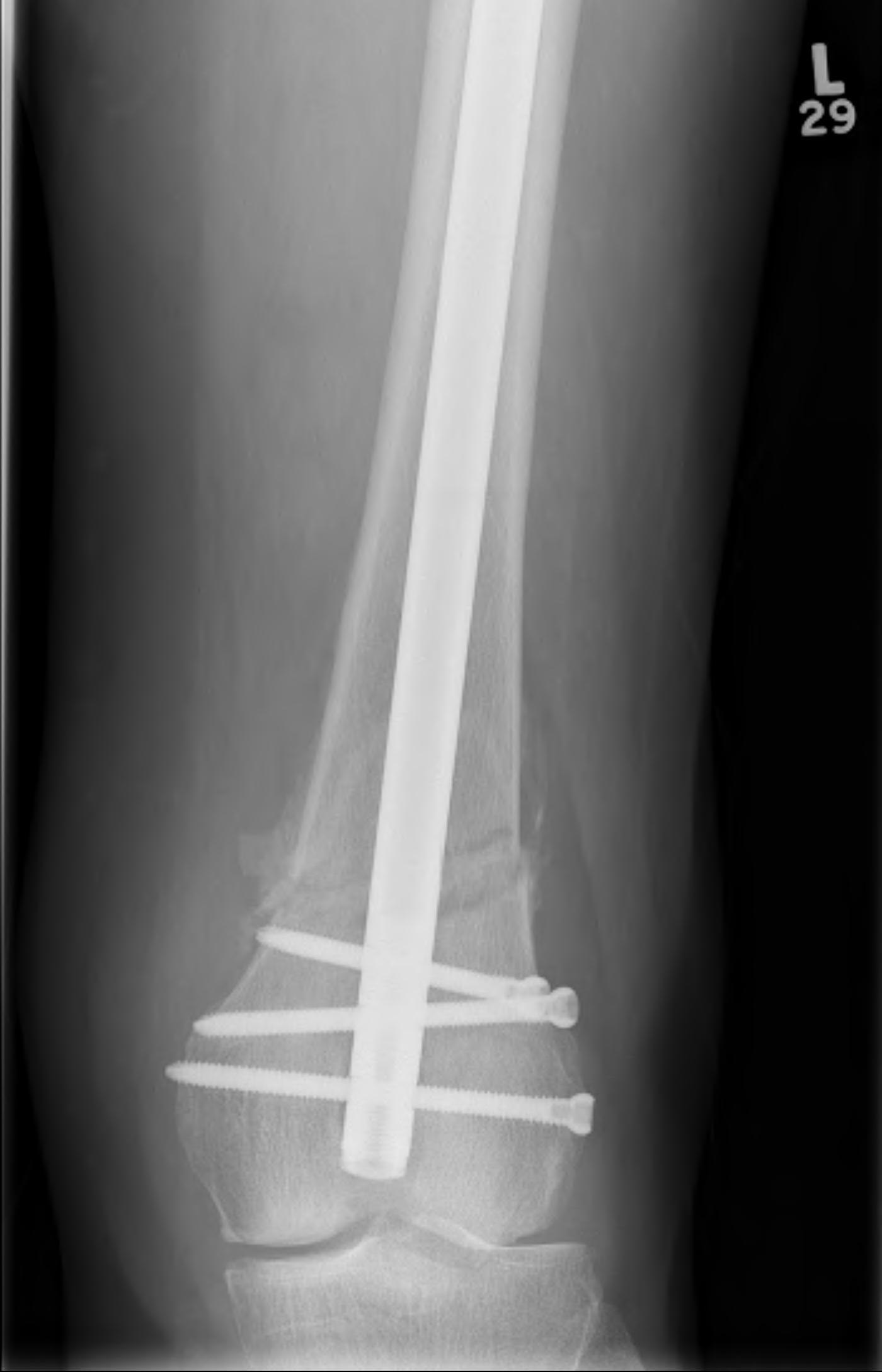 Supracondylar Femur Fracture Retrograde Nail0004